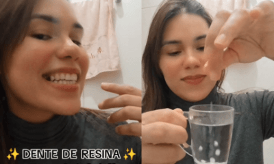 Perigo na web: Dentista alerta sobre os riscos do uso de resina caseira nos dentes