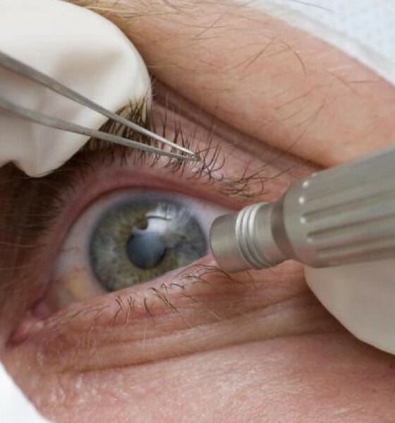 Lula faz cirurgia de catarata; entenda a doença e o procedimento