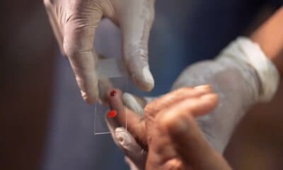 SUS começa a usar novo tratamento contra a malária em crianças