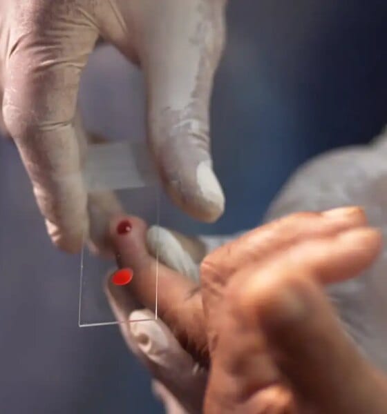 SUS começa a usar novo tratamento contra a malária em crianças